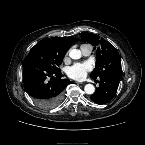 File:Bronchogenic adenocarcinoma and pulmonary embolism (Radiopaedia 9097-9806 D 35).jpg