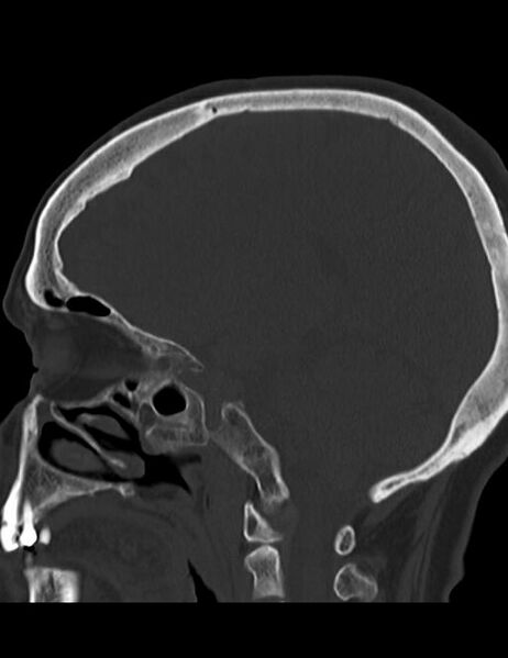 File:Burnt-out meningioma (Radiopaedia 51557-57337 Sagittal bone window 18).jpg
