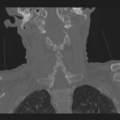 C2 fracture with vertebral artery dissection (Radiopaedia 37378-39199 Axial bone window 1).png