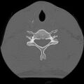 C5 facet fracture (Radiopaedia 58374-65499 Axial bone window 62).jpg
