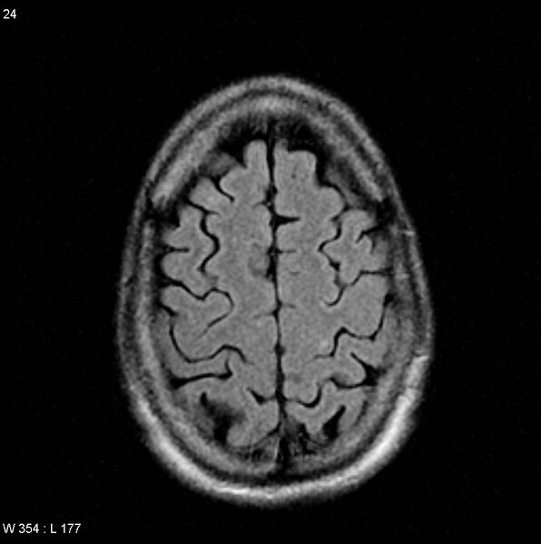 File:CMV ventriculitis and encephalitis (Radiopaedia 5416-7166 Axial FLAIR 9).jpg