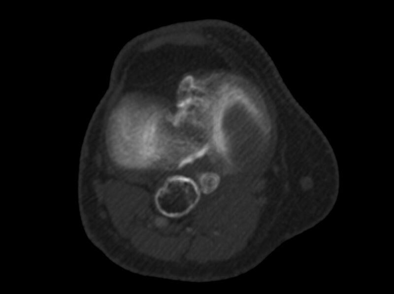 File:Calcified hematoma - popliteal fossa (Radiopaedia 63938-72763 C 29).jpg