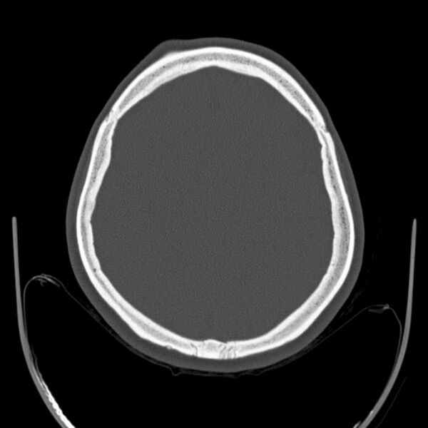File:Calvarial osteoma (Radiopaedia 36520-38079 Axial bone window 77).jpg