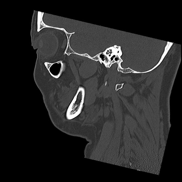 File:Canal up mastoidectomy (Radiopaedia 78108-90638 Sagittal bone window 18).jpg