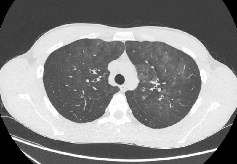 File:Cannabis-induced diffuse alveolar hemorrhage (Radiopaedia 89834-106946 Axial lung window 34).jpg