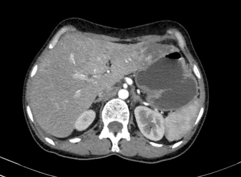 File:Cannonball metastases from breast cancer (Radiopaedia 91024-108569 A 120).jpg