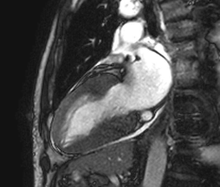 File:Cardiac amyloidosis (Radiopaedia 39736-42124 B 17).jpg