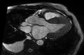 Cardiac amyloidosis (Radiopaedia 61600-69579 B 9).jpg