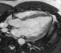 Cardiac sarcoidosis (Radiopaedia 39811-42243 LVOT cine images 27).jpg