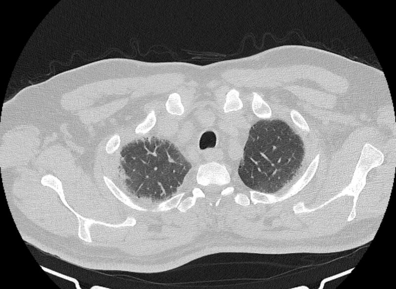File:Cardiogenic pulmonary edema (Radiopaedia 68180-77678 Axial lung window 9).jpg