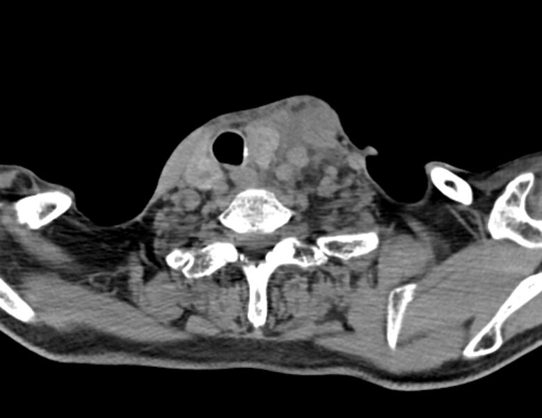 File:Carotid artery pseudoaneurysm (Radiopaedia 84030-99259 Axial non-contrast 45).jpg
