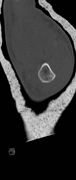 File:Carpal fractures (smart watch impaction) (Radiopaedia 55844-62430 Sagittal bone window 44).jpg