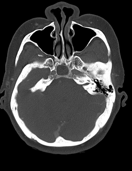 File:Causes of dysphagia (Radiopaedia 40149-42657 Axial bone window 4).png