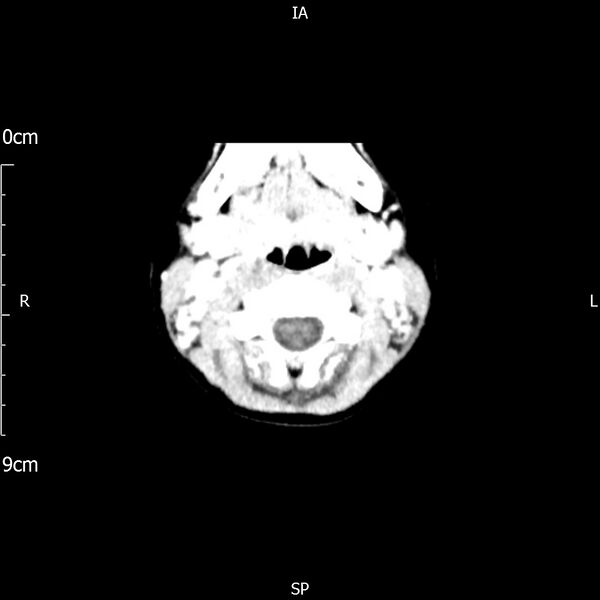 File:Cavernous sinus thrombosis (Radiopaedia 79414-92510 Axial Brain 15).jpg