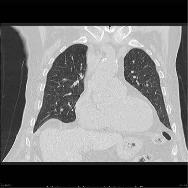 File:Cavitating left lower lobe lesion - squamous cell lung cancer (Radiopaedia 27749-28176 Coronal lung window 19).jpg