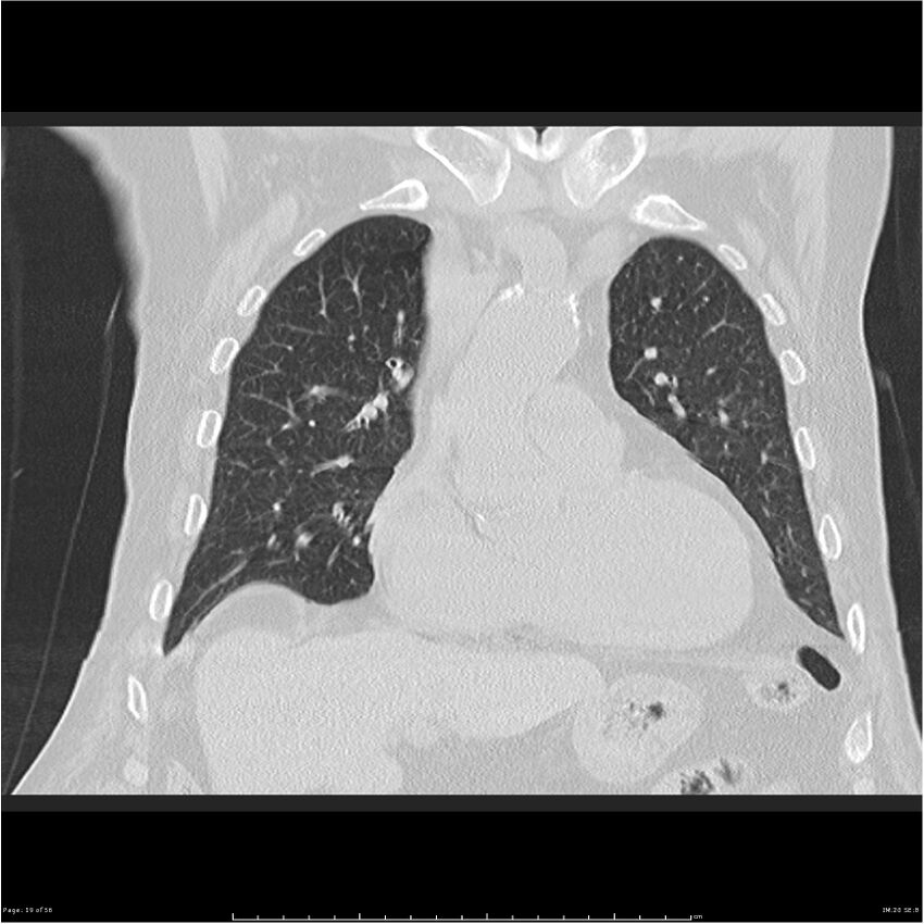 Cavitating left lower lobe lesion - squamous cell lung cancer (Radiopaedia 27749-28176 Coronal lung window 19).jpg