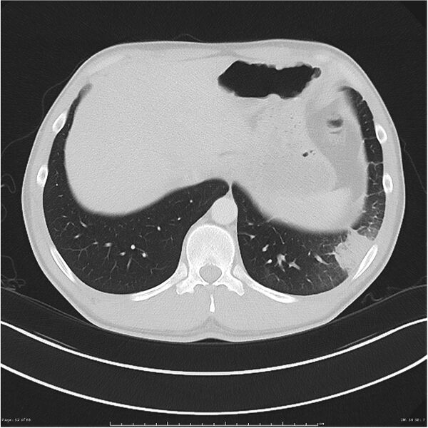 File:Cavitating lung cancer (Radiopaedia 25796-25945 Axial lung window 52).jpg