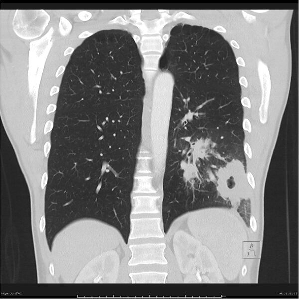 File:Cavitating lung cancer (Radiopaedia 25796-25945 lung window 30).jpg