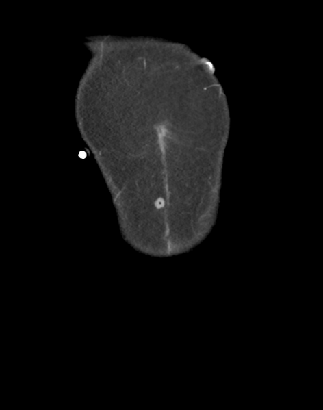 File:Cecum hernia through the foramen of Winslow (Radiopaedia 46634-51112 B 3).png