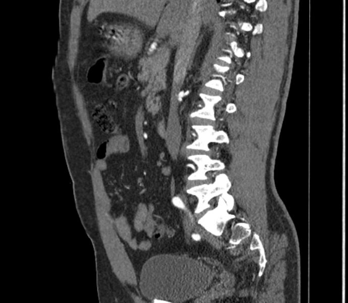 File:Celiac artery dissection (Radiopaedia 52194-58080 B 24).jpg