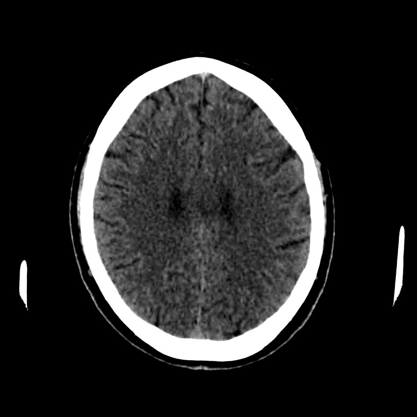 Central nervous system Langerhans cell histiocytosis (Radiopaedia 65728-74878 Axial non-contrast 35).jpg