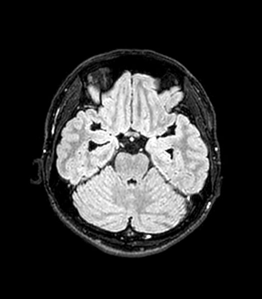 File:Central neurocytoma (Radiopaedia 79320-92380 Axial FLAIR 205).jpg