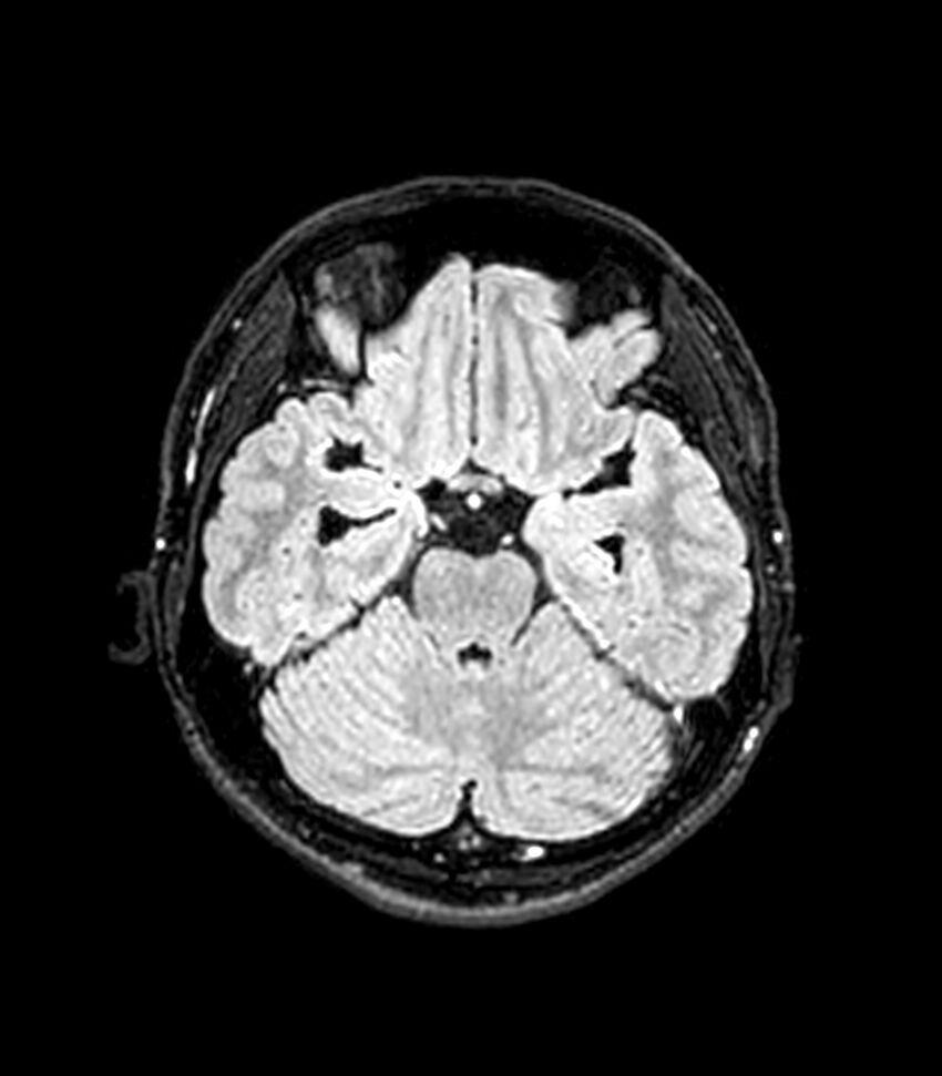 Central neurocytoma (Radiopaedia 79320-92380 Axial FLAIR 205).jpg