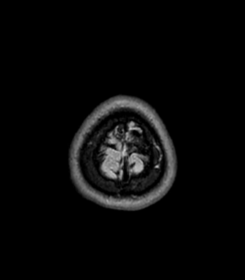 Central neurocytoma (Radiopaedia 79320-92380 Axial FLAIR 36).jpg