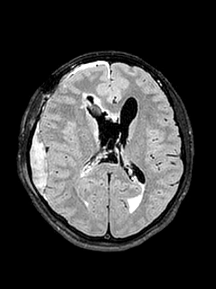 Central neurocytoma (Radiopaedia 79320-92381 Axial FLAIR 79).jpg