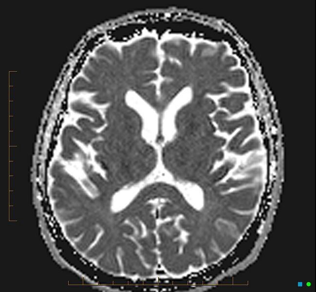 File:Cerebellar gangliocytoma (Radiopaedia 65377-74422 Axial ADC 21).jpg
