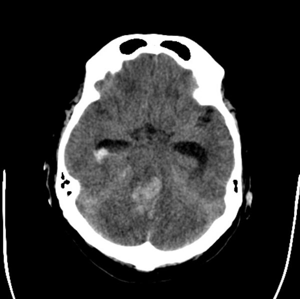 File:Cerebellar hemorrhage causing obstructive hydrocephalus (Radiopaedia 33989-35207 Axial non-contrast 17).jpg