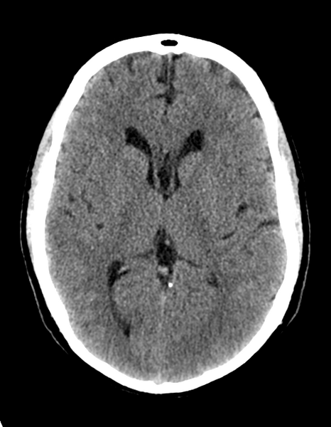 File:Cerebellar infarct due to vertebral artery dissection with posterior fossa decompression (Radiopaedia 82779-97030 Axial non-contrast 18).png