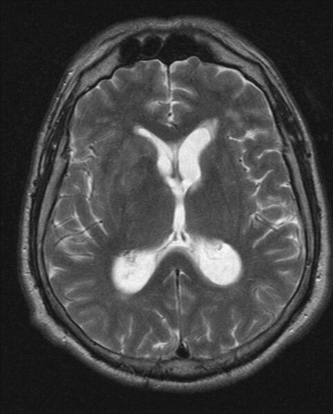 File:Cerebellopontine angle meningioma (Radiopaedia 24459-24764 Axial T2 13).jpg