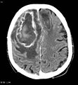 Cerebral abscesses secondary to contusions (Radiopaedia 5201-6967 Axial C+ delayed 6).jpg