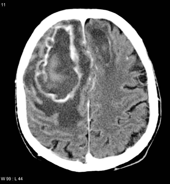 File:Cerebral abscesses secondary to contusions (Radiopaedia 5201-6967 Axial C+ delayed 6).jpg