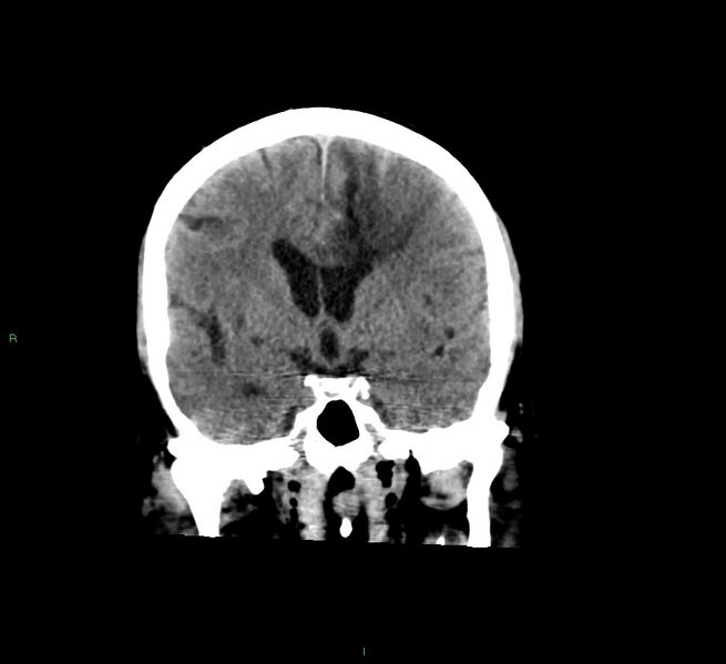 File:Cerebral amyloid angiopathy-associated lobar intracerebral hemorrhage (Radiopaedia 58529-65681 Coronal non-contrast 39).jpg