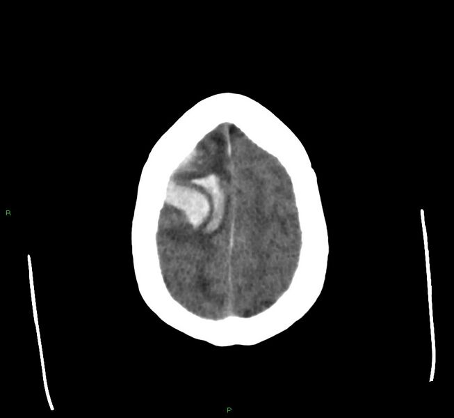File:Cerebral amyloid angiopathy-associated lobar intracerebral hemorrhage (Radiopaedia 58560-65723 Axial non-contrast 11).jpg