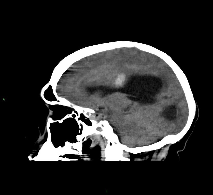 Cerebral amyloid angiopathy-associated lobar intracerebral hemorrhage (Radiopaedia 58560-65723 C 31).jpg