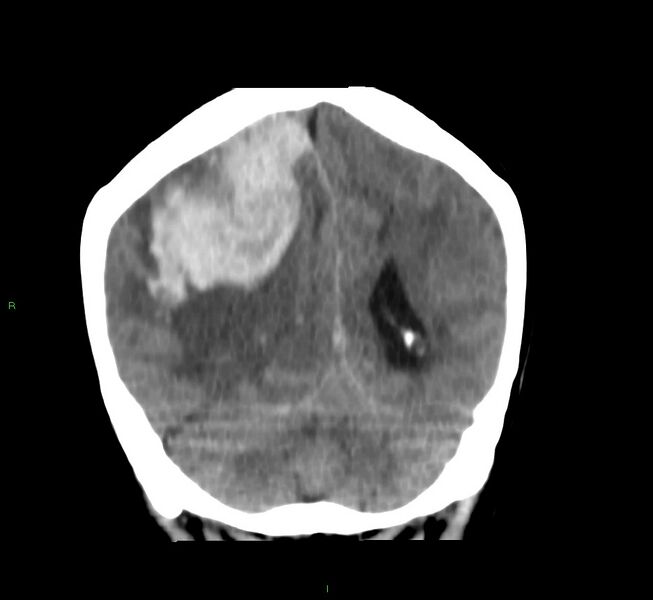 File:Cerebral amyloid angiopathy-associated lobar intracerebral hemorrhage (Radiopaedia 58751-65972 Coronal non-contrast 21).jpg