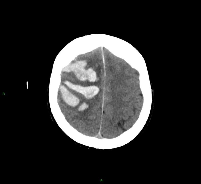 Cerebral amyloid angiopathy-associated lobar intracerebral hemorrhage (Radiopaedia 58756-65977 Axial non-contrast 15).jpg