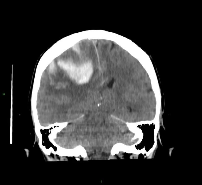 File:Cerebral amyloid angiopathy-associated lobar intracerebral hemorrhage (Radiopaedia 58756-65977 Coronal non-contrast 29).jpg