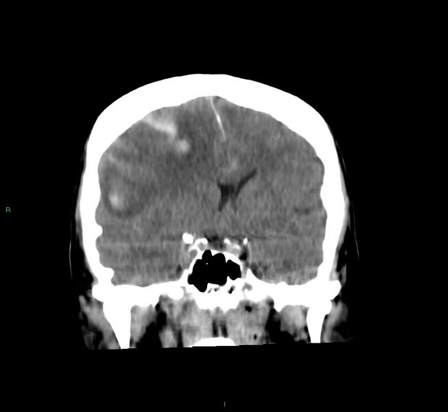 File:Cerebral amyloid angiopathy-associated lobar intracerebral hemorrhage (Radiopaedia 58756-65977 Coronal non-contrast 40).jpg