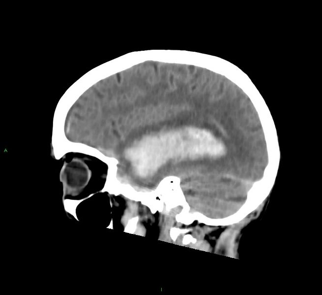 File:Cerebral amyloid angiopathy-associated lobar intracerebral hemorrhage (Radiopaedia 58758-65980 C 18).jpg