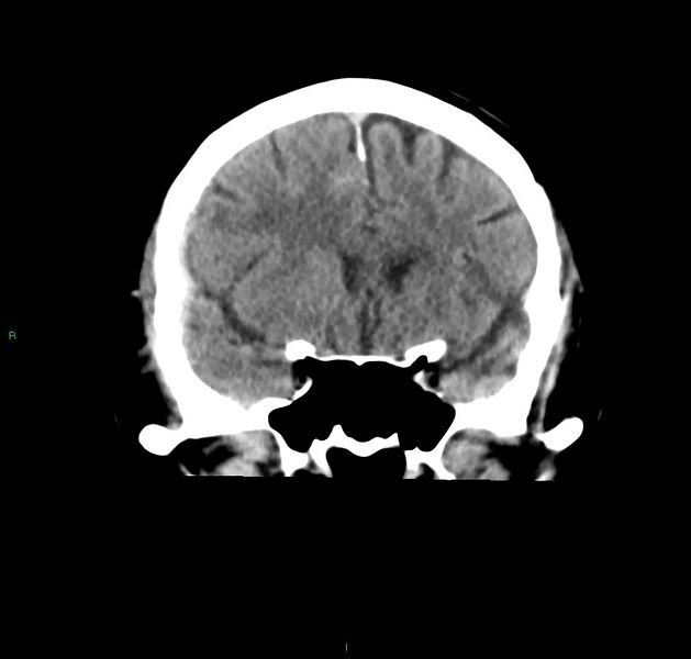 File:Cerebral amyloid angiopathy-associated lobar intracerebral hemorrhage (Radiopaedia 59356-66716 Coronal non-contrast 44).jpg