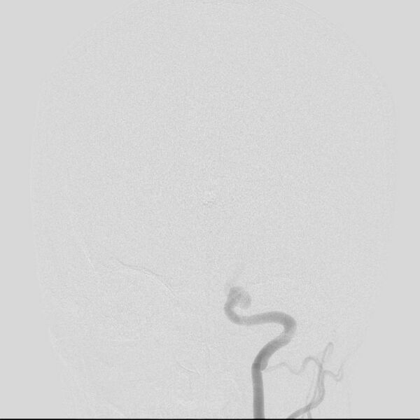 File:Cerebral aneurysm with rupture (Radiopaedia 29933-30458 LT CCA IC 12).jpg
