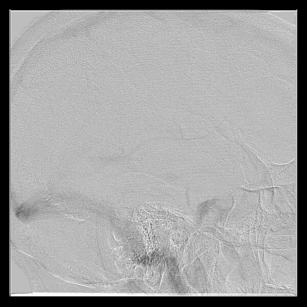 File:Cerebral aneurysm with rupture (Radiopaedia 29933-30458 LT CCA IC 51).jpg