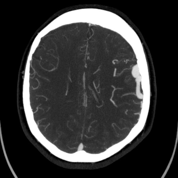 File:Cerebral arteriovenous malformation (Radiopaedia 43729-47189 B 32).jpg