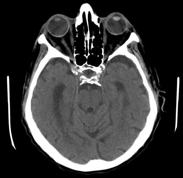 File:Cerebral atrophy (Radiopaedia 11287-11651 Axial 1).jpg