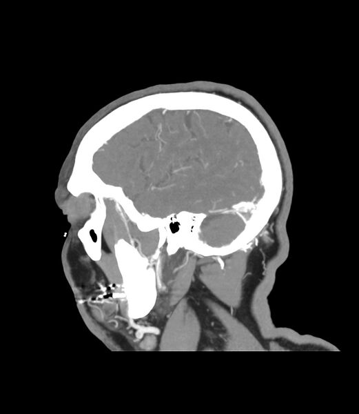 File:Cerebral dural venous sinus thrombosis (Radiopaedia 86514-102576 C 49).jpg
