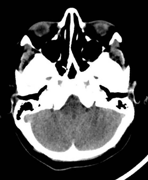 File:Cerebral edema due to severe hyponatremia (Radiopaedia 89826-106937 Axial non-contrast 17).jpg